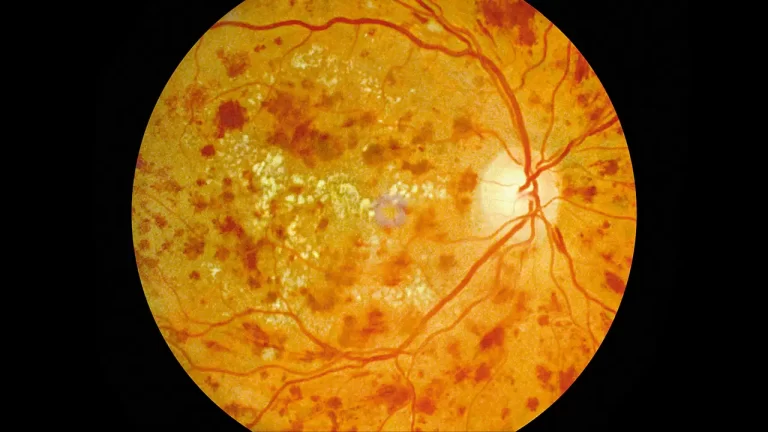 diabetic retinopathy