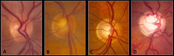 glaucoma