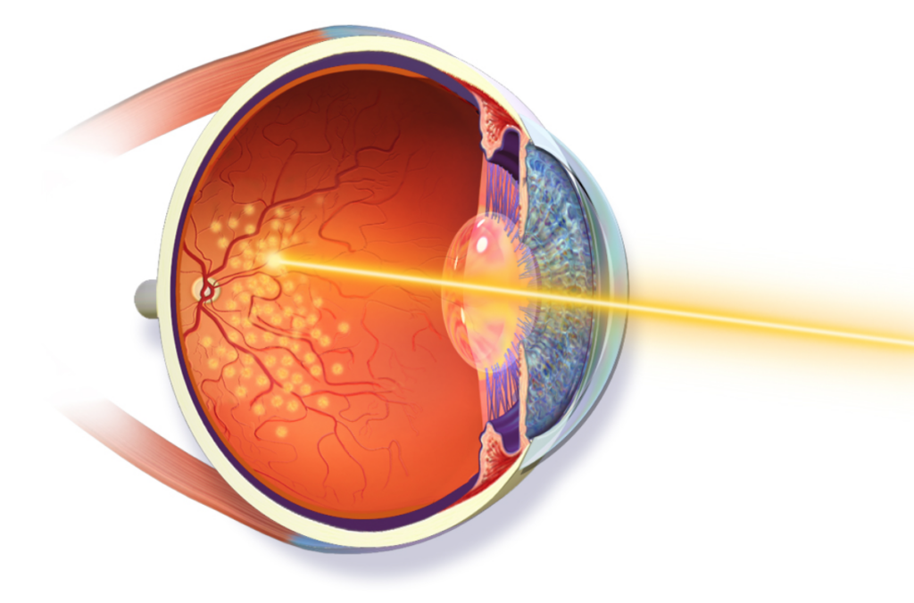 diabetic retinopathy