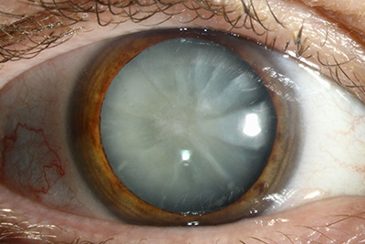 cataracts